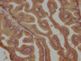 IHC image diluted at 1:800 and staining in paraffin-embedded human prostate tissue performed on a Leica BondTM system. After dewaxing and hydration, antigen retrieval was mediated by high pressure in a citrate buffer (pH 6.0). Section was blocked with 10% normal goat serum 30min at RT. Then primary antibody (1% BSA) was incubated at 4°C overnight. The primary is detected by a biotinylated secondary antibody and visualized using an HRP conjugated SP system.