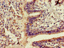 Immunohistochemistry of paraffin-embedded human lung cancer using CAC11718 at dilution of 1:100