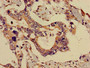Immunohistochemistry of paraffin-embedded human pancreatic cancer using CAC11718 at dilution of 1:100