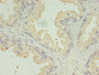 Immunohistochemistry of paraffin-embedded human prostate cancer using CAC11727 at dilution of 1:100 Immunohistochemistry of paraffin-embedded human prostate cancer using CAC11727 at dilution of 1:100
