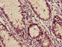 Immunohistochemistry of paraffin-embedded human colon cancer using CAC11745 at dilution of 1:100