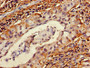 Immunohistochemistry of paraffin-embedded human lung cancer using CAC11772 at dilution of 1:100