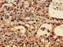 Immunohistochemistry of paraffin-embedded human lung cancer using CAC11784 at dilution of 1:100