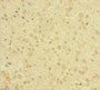 Immunohistochemistry of paraffin-embedded human glioma using CAC11825 at dilution of 1:100 Immunohistochemistry of paraffin-embedded human glioma using CAC11825 at dilution of 1:100