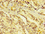 IHC image of CAC11826 diluted at 1:400 and staining in paraffin-embedded human prostate cancer performed on a Leica BondTM system. After dewaxing and hydration, antigen retrieval was mediated by high pressure in a citrate buffer (pH 6.0). Section was blocked with 10% normal goat serum 30min at RT. Then primary antibody (1% BSA) was incubated at 4°C overnight. The primary is detected by a biotinylated secondary antibody and visualized using an HRP conjugated SP system.