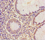Immunohistochemistry of paraffin-embedded human colon cancer using CAC11841 at dilution of 1:100 Immunohistochemistry of paraffin-embedded human colon cancer using CAC11841 at dilution of 1:100
