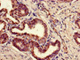 Immunohistochemistry of paraffin-embedded human prostate cancer using CAC11854 at dilution of 1:100