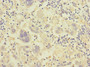 Immunohistochemistry of paraffin-embedded human liver cancer using CAC12822 at dilution of 1:100 Immunohistochemistry of paraffin-embedded human liver cancer using CAC12822 at dilution of 1:100