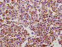 IHC image of CAC12827 diluted at 1:100 and staining in paraffin-embedded human lung cancer tissue performed on a Leica BondTM system. After dewaxing and hydration, antigen retrieval was mediated by high pressure in a citrate buffer (pH 6.0). Section was blocked with 10% normal goat serum 30min at RT. Then primary antibody (1% BSA) was incubated at 4°C overnight. The primary is detected by a biotinylated secondary antibody and visualized using an HRP conjugated SP system.