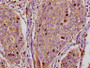 IHC image of CAC12827 diluted at 1:100 and staining in paraffin-embedded human cervical cancer tissue performed on a Leica BondTM system. After dewaxing and hydration, antigen retrieval was mediated by high pressure in a citrate buffer (pH 6.0). Section was blocked with 10% normal goat serum 30min at RT. Then primary antibody (1% BSA) was incubated at 4°C overnight. The primary is detected by a biotinylated secondary antibody and visualized using an HRP conjugated SP system.