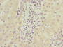 Immunohistochemistry of paraffin-embedded human liver cancer using CAC12838 at dilution of 1:100 Immunohistochemistry of paraffin-embedded human liver cancer using CAC12838 at dilution of 1:100