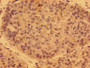 Immunohistochemistry of paraffin-embedded human liver cancer using CAC12843 at dilution of 1:100 Immunohistochemistry of paraffin-embedded human liver cancer using CAC12843 at dilution of 1:100