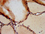 IHC image of CAC12863 diluted at 1:700 and staining in paraffin-embedded human thyroid tissue performed on a Leica BondTM system. After dewaxing and hydration, antigen retrieval was mediated by high pressure in a citrate buffer (pH 6.0). Section was blocked with 10% normal goat serum 30min at RT. Then primary antibody (1% BSA) was incubated at 4°C overnight. The primary is detected by a biotinylated secondary antibody and visualized using an HRP conjugated SP system. IHC image of CAC12863 diluted at 1:700 and staining in paraffin-embedded human thyroid tissue performed on a Leica BondTM system. After dewaxing and hydration, antigen retrieval was mediated by high pressure in a citrate buffer (pH 6.0). Section was blocked with 10% normal goat serum 30min at RT. Then primary antibody (1% BSA) was incubated at 4°C overnight. The primary is detected by a biotinylated secondary antibody and visualized using an HRP conjugated SP system.