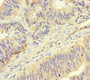 Immunohistochemistry of paraffin-embedded human colon cancer using CAC12888 at dilution of 1:100