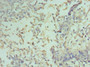 Immunohistochemistry of paraffin-embedded human cervical cancer using CAC12894 at dilution of 1:100