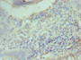 Immunohistochemistry of paraffin-embedded human colon cancer using CAC12894 at dilution of 1:100