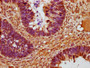 IHC image of CAC12894 diluted at 1:225 and staining in paraffin-embedded human ovarian cancer performed on a Leica BondTM system. After dewaxing and hydration, antigen retrieval was mediated by high pressure in a citrate buffer (pH 6.0). Section was blocked with 10% normal goat serum 30min at RT. Then primary antibody (1% BSA) was incubated at 4°C overnight. The primary is detected by a biotinylated secondary antibody and visualized using an HRP conjugated SP system.