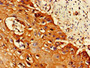 Immunohistochemistry of paraffin-embedded human cervical cancer using CAC12918 at dilution of 1:100