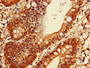 Immunohistochemistry of paraffin-embedded human colon cancer using CAC12918 at dilution of 1:100