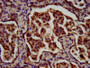 IHC image of CAC12921 diluted at 1:700 and staining in paraffin-embedded human lung cancer performed on a Leica BondTM system. After dewaxing and hydration, antigen retrieval was mediated by high pressure in a citrate buffer (pH 6.0). Section was blocked with 10% normal goat serum 30min at RT. Then primary antibody (1% BSA) was incubated at 4°C overnight. The primary is detected by a biotinylated secondary antibody and visualized using an HRP conjugated SP system.