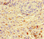 Immunohistochemistry of paraffin-embedded human melanoma using CAC12931 at dilution of 1:100