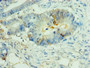 Immunohistochemistry of paraffin-embedded human colon cancer using CAC12958 at dilution of 1:100 Immunohistochemistry of paraffin-embedded human colon cancer using CAC12958 at dilution of 1:100