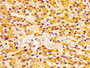 Immunohistochemistry of paraffin-embedded human liver cancer using CAC12983 at dilution of 1:100 Immunohistochemistry of paraffin-embedded human liver cancer using CAC12983 at dilution of 1:100