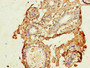 Immunohistochemistry of paraffin-embedded human breast cancer using CAC13007 at dilution of 1:100 Immunohistochemistry of paraffin-embedded human breast cancer using CAC13007 at dilution of 1:100