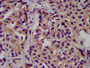 IHC image of CAC13011 diluted at 1:500 and staining in paraffin-embedded human liver cancer performed on a Leica BondTM system. After dewaxing and hydration, antigen retrieval was mediated by high pressure in a citrate buffer (pH 6.0). Section was blocked with 10% normal goat serum 30min at RT. Then primary antibody (1% BSA) was incubated at 4°C overnight. The primary is detected by a biotinylated secondary antibody and visualized using an HRP conjugated SP system. IHC image of CAC13011 diluted at 1:500 and staining in paraffin-embedded human liver cancer performed on a Leica BondTM system. After dewaxing and hydration, antigen retrieval was mediated by high pressure in a citrate buffer (pH 6.0). Section was blocked with 10% normal goat serum 30min at RT. Then primary antibody (1% BSA) was incubated at 4°C overnight. The primary is detected by a biotinylated secondary antibody and visualized using an HRP conjugated SP system.
