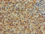 Immunohistochemistry of paraffin-embedded human liver cancer using CAC13018 at dilution of 1:100 Immunohistochemistry of paraffin-embedded human liver cancer using CAC13018 at dilution of 1:100