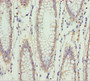 Immunohistochemistry of paraffin-embedded human colon cancer using CAC13031 at dilution of 1:100 Immunohistochemistry of paraffin-embedded human colon cancer using CAC13031 at dilution of 1:100