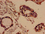 Immunohistochemistry analysis of human pancreatic cancer using CAC13032 at dilution of 1:100 Immunohistochemistry analysis of human pancreatic cancer using CAC13032 at dilution of 1:100