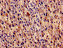 Immunocytochemistry analysis of human liver cancer using CAC13032 at dilution of 1:100 Immunocytochemistry analysis of human liver cancer using CAC13032 at dilution of 1:100