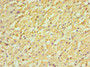 Immunohistochemistry of paraffin-embedded human liver cancer using CAC13036 at dilution of 1:100 Immunohistochemistry of paraffin-embedded human liver cancer using CAC13036 at dilution of 1:100