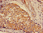 Immunohistochemistry of paraffin-embedded human breast cancer using CAC13041 at dilution of 1:100 Immunohistochemistry of paraffin-embedded human breast cancer using CAC13041 at dilution of 1:100