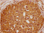 IHC image of CAC13045 diluted at 1:100 and staining in paraffin-embedded human breast cancer performed on a Leica BondTM system. After dewaxing and hydration, antigen retrieval was mediated by high pressure in a citrate buffer (pH 6.0). Section was blocked with 10% normal goat serum 30min at RT. Then primary antibody (1% BSA) was incubated at 4°C overnight. The primary is detected by a biotinylated secondary antibody and visualized using an HRP conjugated SP system.