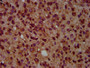 IHC image of CAC13048 diluted at 1:500 and staining in paraffin-embedded human glioma performed on a Leica BondTM system. After dewaxing and hydration, antigen retrieval was mediated by high pressure in a citrate buffer (pH 6.0). Section was blocked with 10% normal goat serum 30min at RT. Then primary antibody (1% BSA) was incubated at 4°C overnight. The primary is detected by a biotinylated secondary antibody and visualized using an HRP conjugated SP system.