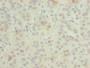 Immunohistochemistry of paraffin-embedded human liver cancer using CAC13051 at dilution of 1:100