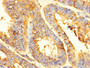 Immunohistochemistry of paraffin-embedded human endometrial cancer using CAC13052 at dilution of 1:100 Immunohistochemistry of paraffin-embedded human endometrial cancer using CAC13052 at dilution of 1:100