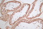 Immunohistochemistry of paraffin-embedded human colon cancer using CAC13057 at dilution of 1:100