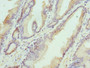 Immunohistochemistry of paraffin-embedded human prostate cancer using CAC13059 at dilution of 1:100