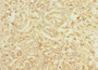 Immunohistochemistry of paraffin-embedded human pancreatic cancer using CAC13062 at dilution of 1:100