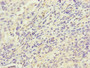 Immunohistochemistry of paraffin-embedded human lung cancer using CAC13077 at dilution of 1:100