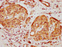 IHC image of CAC13079 diluted at 1:500 and staining in paraffin-embedded human pancreatic cancer performed on a Leica BondTM system. After dewaxing and hydration, antigen retrieval was mediated by high pressure in a citrate buffer (pH 6.0). Section was blocked with 10% normal goat serum 30min at RT. Then primary antibody (1% BSA) was incubated at 4°C overnight. The primary is detected by a biotinylated secondary antibody and visualized using an HRP conjugated SP system.