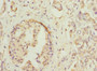 Immunohistochemistry of paraffin-embedded human pancreatic cancer using CAC13080 at dilution of 1:100 Immunohistochemistry of paraffin-embedded human pancreatic cancer using CAC13080 at dilution of 1:100
