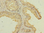 Immunohistochemistry of paraffin-embedded human prostate cancer using CAC13082 at dilution of 1:100