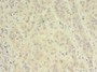 Immunohistochemistry of paraffin-embedded human liver cancer using CAC13131 at dilution of 1:100 Immunohistochemistry of paraffin-embedded human liver cancer using CAC13131 at dilution of 1:100