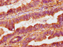 IHC image of CAC13143 diluted at 1:400 and staining in paraffin-embedded human colon cancer performed on a Leica BondTM system. After dewaxing and hydration, antigen retrieval was mediated by high pressure in a citrate buffer (pH 6.0). Section was blocked with 10% normal goat serum 30min at RT. Then primary antibody (1% BSA) was incubated at 4°C overnight. The primary is detected by a biotinylated secondary antibody and visualized using an HRP conjugated SP system. IHC image of CAC13143 diluted at 1:400 and staining in paraffin-embedded human colon cancer performed on a Leica BondTM system. After dewaxing and hydration, antigen retrieval was mediated by high pressure in a citrate buffer (pH 6.0). Section was blocked with 10% normal goat serum 30min at RT. Then primary antibody (1% BSA) was incubated at 4°C overnight. The primary is detected by a biotinylated secondary antibody and visualized using an HRP conjugated SP system.