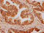 IHC image of CAC13143 diluted at 1:400 and staining in paraffin-embedded human prostate cancer performed on a Leica BondTM system. After dewaxing and hydration, antigen retrieval was mediated by high pressure in a citrate buffer (pH 6.0). Section was blocked with 10% normal goat serum 30min at RT. Then primary antibody (1% BSA) was incubated at 4°C overnight. The primary is detected by a biotinylated secondary antibody and visualized using an HRP conjugated SP system. IHC image of CAC13143 diluted at 1:400 and staining in paraffin-embedded human prostate cancer performed on a Leica BondTM system. After dewaxing and hydration, antigen retrieval was mediated by high pressure in a citrate buffer (pH 6.0). Section was blocked with 10% normal goat serum 30min at RT. Then primary antibody (1% BSA) was incubated at 4°C overnight. The primary is detected by a biotinylated secondary antibody and visualized using an HRP conjugated SP system.
