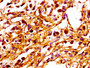 IHC image of CAC13168 diluted at 1:100 and staining in paraffin-embedded human melanoma performed on a Leica BondTM system. After dewaxing and hydration, antigen retrieval was mediated by high pressure in a citrate buffer (pH 6.0). Section was blocked with 10% normal goat serum 30min at RT. Then primary antibody (1% BSA) was incubated at 4°C overnight. The primary is detected by a biotinylated secondary antibody and visualized using an HRP conjugated SP system. IHC image of CAC13168 diluted at 1:100 and staining in paraffin-embedded human melanoma performed on a Leica BondTM system. After dewaxing and hydration, antigen retrieval was mediated by high pressure in a citrate buffer (pH 6.0). Section was blocked with 10% normal goat serum 30min at RT. Then primary antibody (1% BSA) was incubated at 4°C overnight. The primary is detected by a biotinylated secondary antibody and visualized using an HRP conjugated SP system.